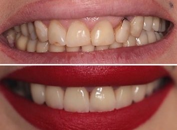 Комплексная реабилитация зубов, цельнокерамические коронки.